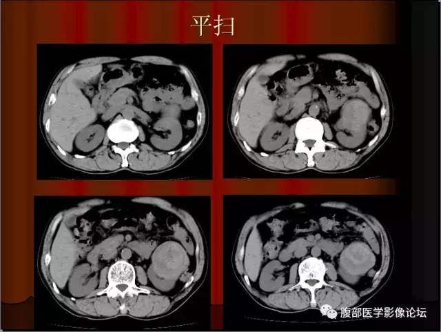 【病例】左肾乳头状细胞癌1例CT影像表现