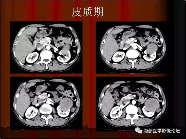 【病例】左肾乳头状细胞癌1例CT影像表现
