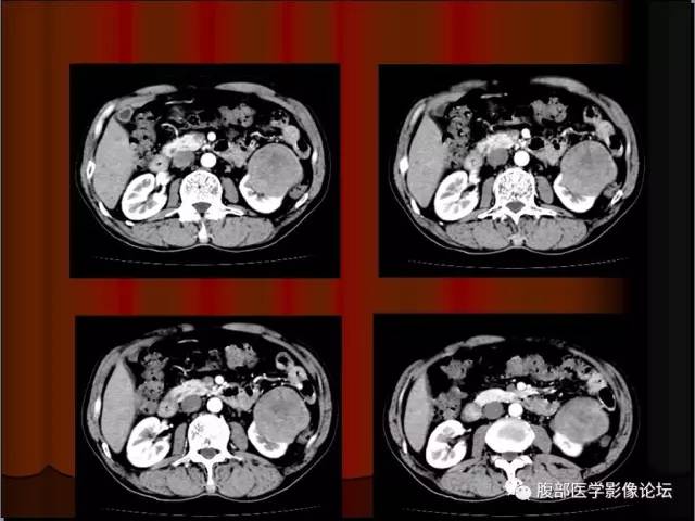 【病例】左肾乳头状细胞癌1例CT影像表现