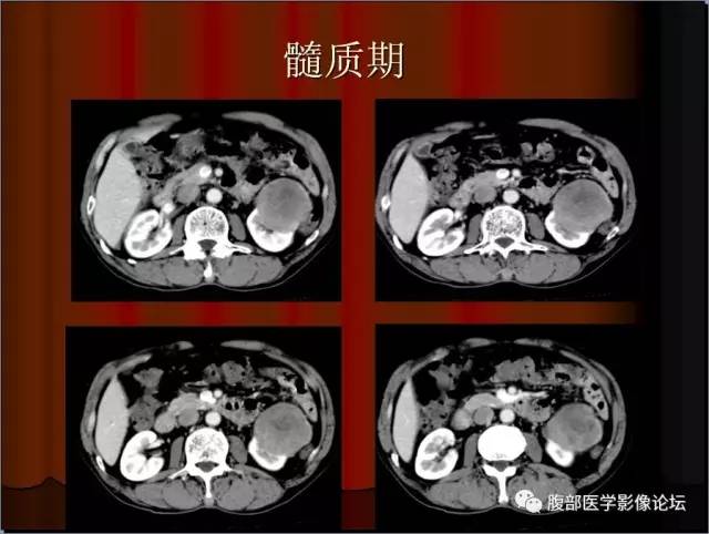 【病例】左肾乳头状细胞癌1例CT影像表现