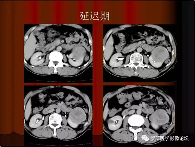 【病例】左肾乳头状细胞癌1例CT影像表现