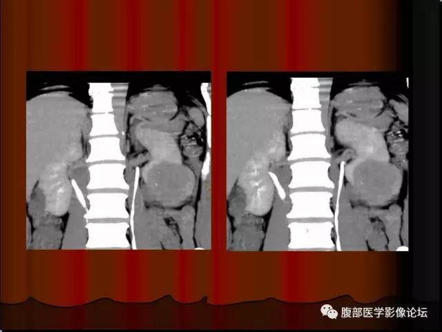 【病例】左肾乳头状细胞癌1例CT影像表现