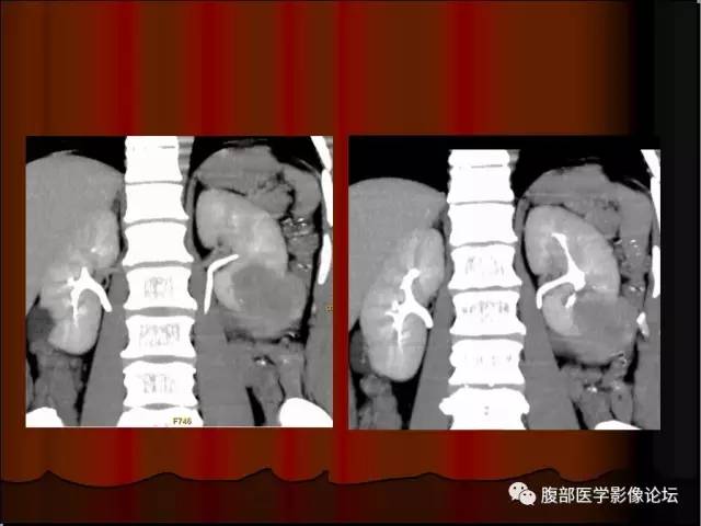 【病例】左肾乳头状细胞癌1例CT影像表现