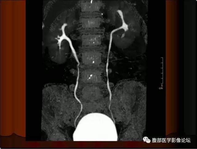 【病例】左肾乳头状细胞癌1例CT影像表现