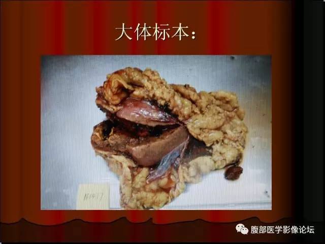 【病例】左肾乳头状细胞癌1例CT影像表现