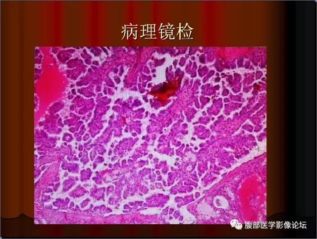 【病例】左肾乳头状细胞癌1例CT影像表现