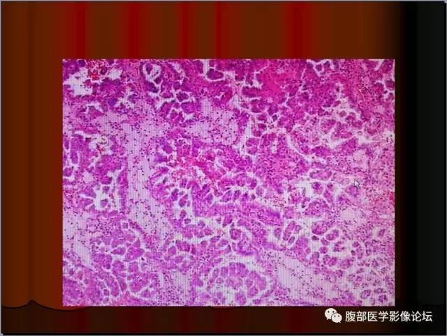 【病例】左肾乳头状细胞癌1例CT影像表现