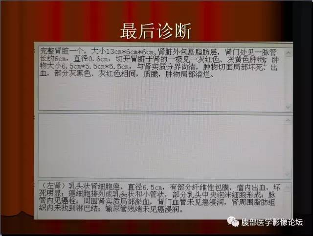 【病例】左肾乳头状细胞癌1例CT影像表现