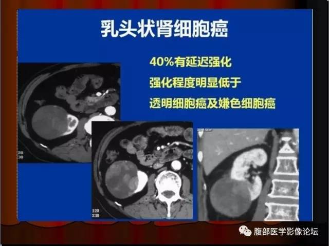 【病例】左肾乳头状细胞癌1例CT影像表现