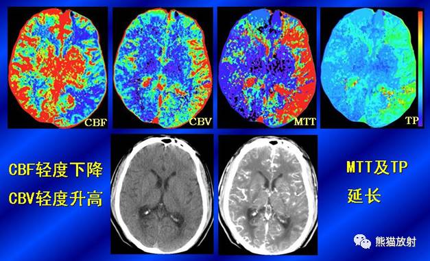 【影像病理】脑血管疾病——脑梗死 【影像病理】脑血管疾病——脑梗死