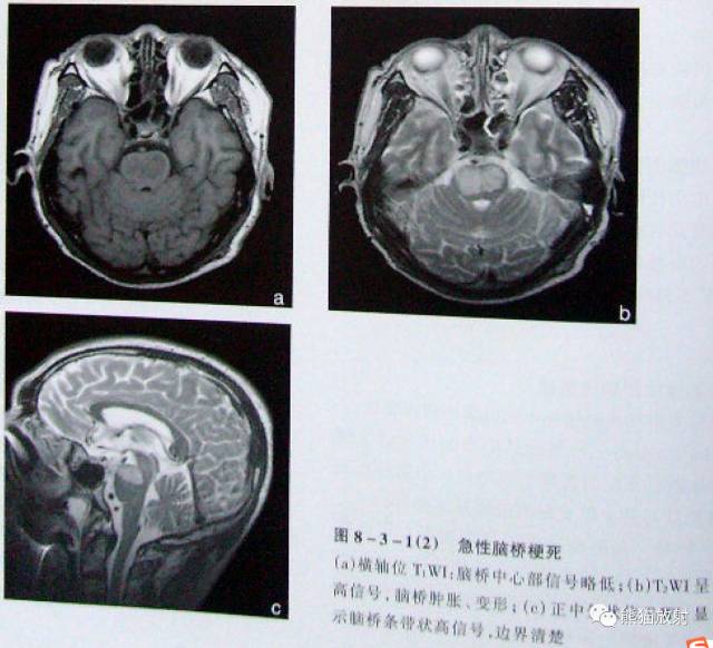 【影像病理】脑血管疾病——脑梗死 【影像病理】脑血管疾病——脑梗死