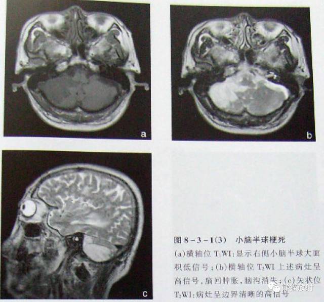 【影像病理】脑血管疾病——脑梗死 【影像病理】脑血管疾病——脑梗死