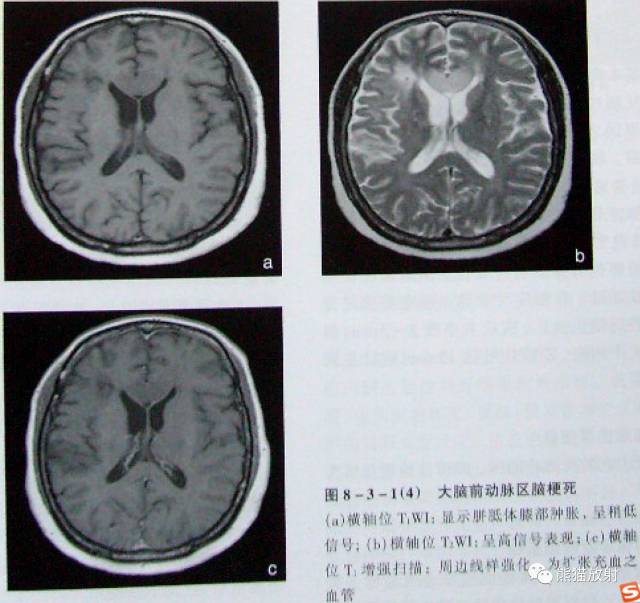 【影像病理】脑血管疾病——脑梗死 【影像病理】脑血管疾病——脑梗死