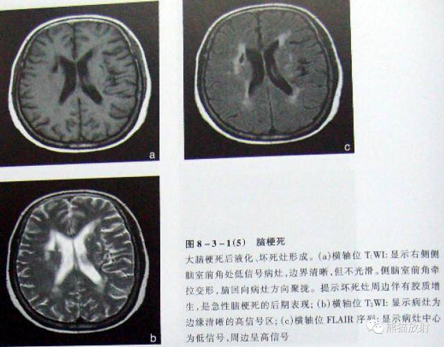 【影像病理】脑血管疾病——脑梗死 【影像病理】脑血管疾病——脑梗死