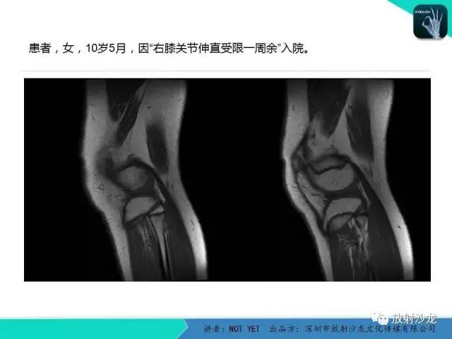 【病例】右膝盘状半月板伴损伤1例MR