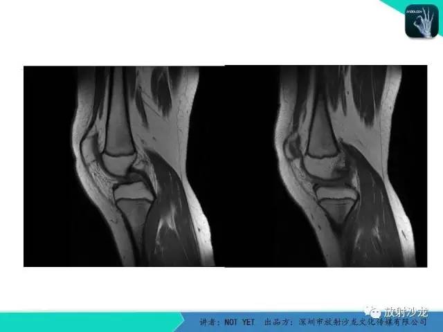 【病例】右膝盘状半月板伴损伤1例MR