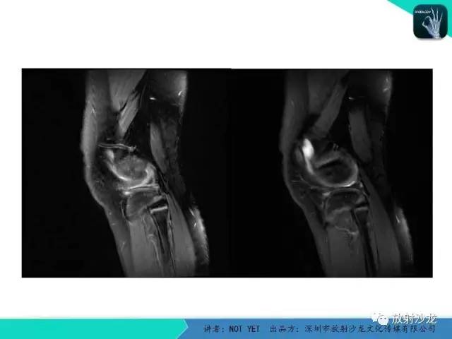【病例】右膝盘状半月板伴损伤1例MR