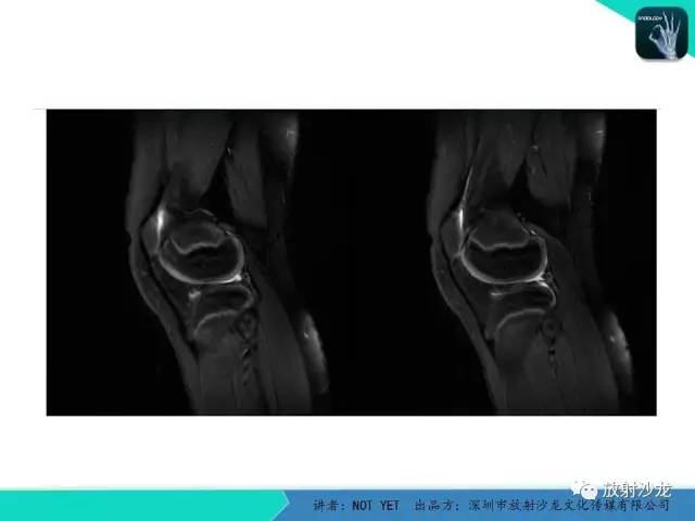 【病例】右膝盘状半月板伴损伤1例MR