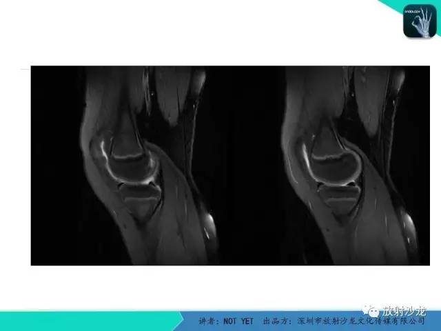 【病例】右膝盘状半月板伴损伤1例MR
