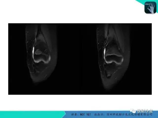 【病例】右膝盘状半月板伴损伤1例MR