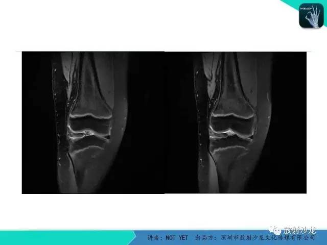 【病例】右膝盘状半月板伴损伤1例MR