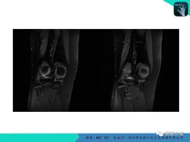 【病例】右膝盘状半月板伴损伤1例MR