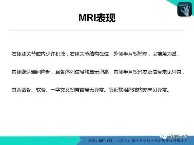 【病例】右膝盘状半月板伴损伤1例MR