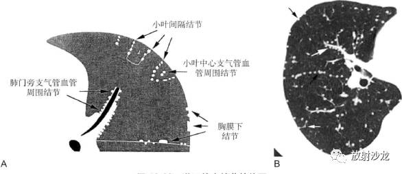 弥漫性浸润性肺疾病的HRCT表现 弥漫性浸润性肺疾病的HRCT表现