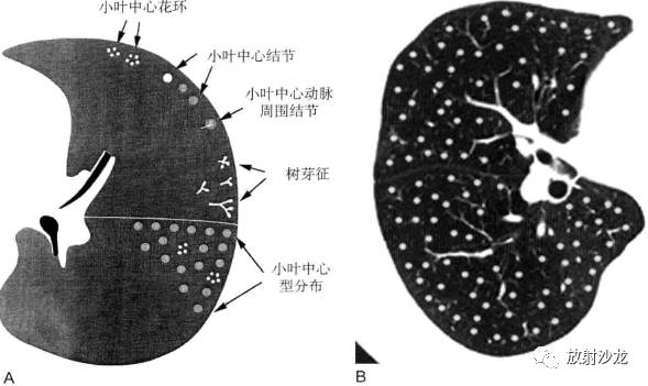 弥漫性浸润性肺疾病的HRCT表现 弥漫性浸润性肺疾病的HRCT表现