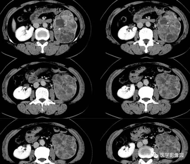 【病例】肾脏肿瘤多囊——透明细胞癌1例CT 【病例】肾脏肿瘤多囊——透明细胞癌1例CT