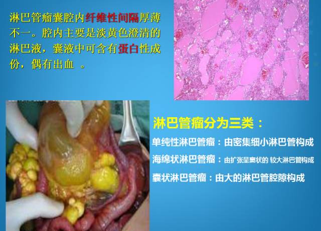 【PPT】脾脏肿瘤CT诊断