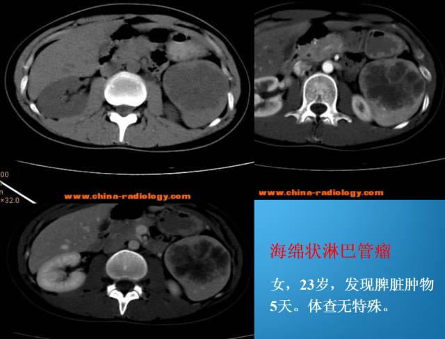 【PPT】脾脏肿瘤CT诊断