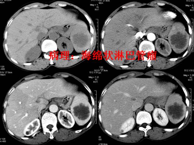 【PPT】脾脏肿瘤CT诊断
