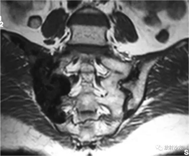 【病例】右侧骶髂关节结核伴钙化1例CT及MR 【病例】右侧骶髂关节结核伴钙化1例CT及MR