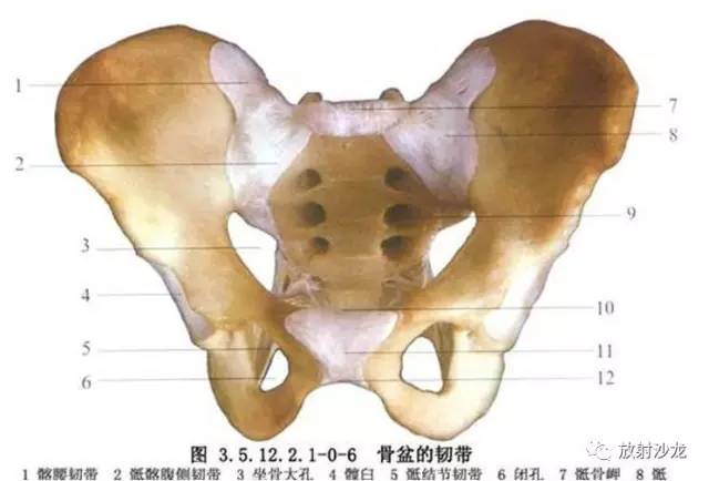 【病例】右侧骶髂关节结核伴钙化1例CT及MR 【病例】右侧骶髂关节结核伴钙化1例CT及MR