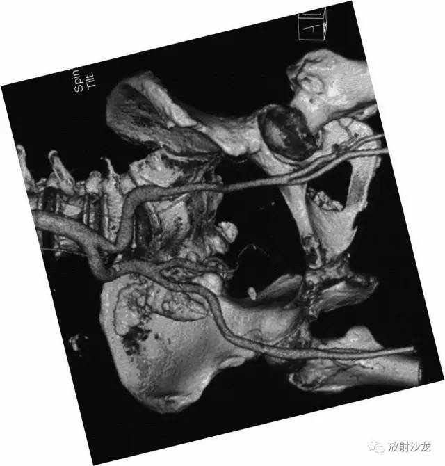 【病例】右侧骶髂关节结核伴钙化1例CT及MR 【病例】右侧骶髂关节结核伴钙化1例CT及MR