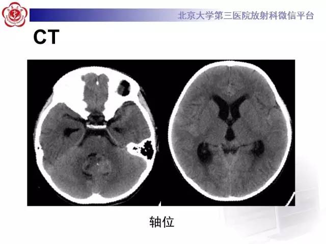 【病例】髓母细胞瘤1例MR影像诊断与鉴别