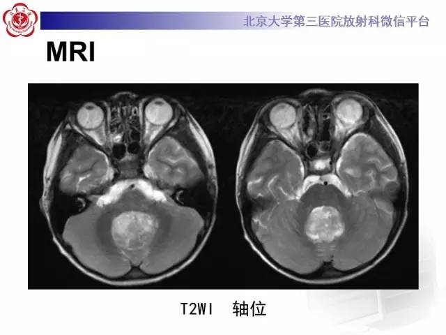 【病例】髓母细胞瘤1例MR影像诊断与鉴别