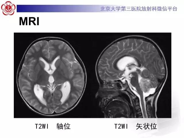 【病例】髓母细胞瘤1例MR影像诊断与鉴别