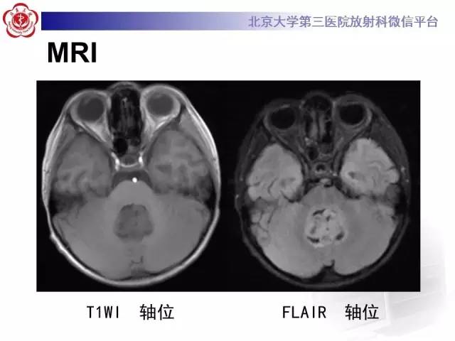 【病例】髓母细胞瘤1例MR影像诊断与鉴别