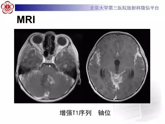 【病例】髓母细胞瘤1例MR影像诊断与鉴别