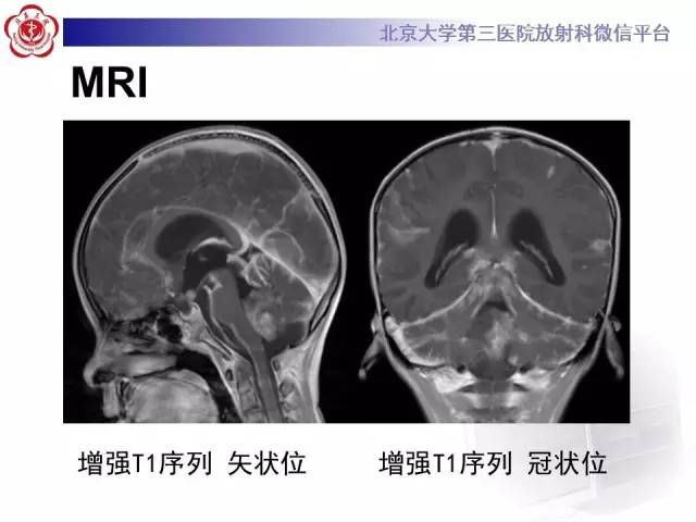 【病例】髓母细胞瘤1例MR影像诊断与鉴别
