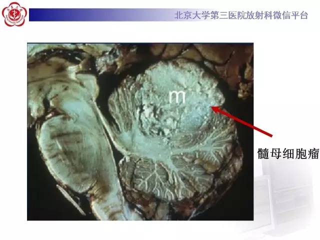 【病例】髓母细胞瘤1例MR影像诊断与鉴别
