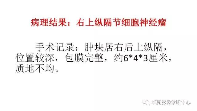 【病例】纵隔节细胞神经瘤1例CT影像表现
