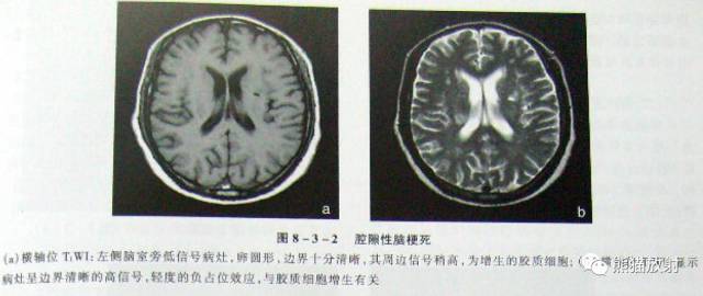 【影像病理】脑血管疾病——腔隙性脑梗死、出血性脑梗死、皮层下动脉硬化性脑病