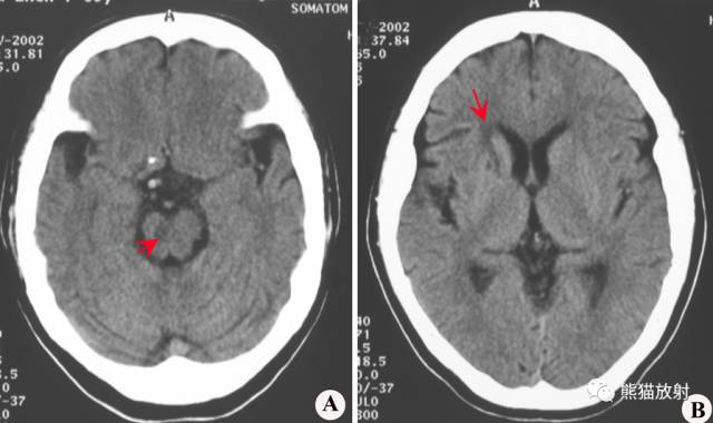 【影像病理】脑血管疾病——腔隙性脑梗死、出血性脑梗死、皮层下动脉硬化性脑病