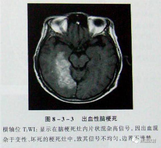 【影像病理】脑血管疾病——腔隙性脑梗死、出血性脑梗死、皮层下动脉硬化性脑病 【影像病理】脑血管疾病——腔隙性脑梗死、出血性脑梗死、皮层下动脉硬化性脑病