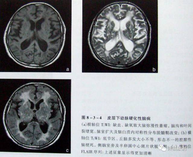 【影像病理】脑血管疾病——腔隙性脑梗死、出血性脑梗死、皮层下动脉硬化性脑病 【影像病理】脑血管疾病——腔隙性脑梗死、出血性脑梗死、皮层下动脉硬化性脑病