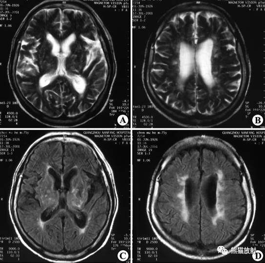 【影像病理】脑血管疾病——腔隙性脑梗死、出血性脑梗死、皮层下动脉硬化性脑病 【影像病理】脑血管疾病——腔隙性脑梗死、出血性脑梗死、皮层下动脉硬化性脑病