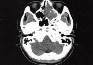 【病例】鼻腔鼻窦嗅神经母细胞瘤1例CT影像表现分析 【病例】鼻腔鼻窦嗅神经母细胞瘤1例CT影像表现分析